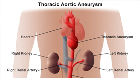 thoracic aneurysm  treatment doctor in ahmedabad